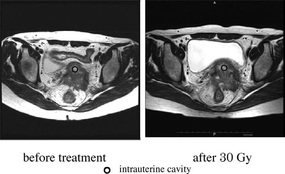 Hybrid-brachytherapy for Cervical Cancer 55 Fig. 1. MRI images before treatment and after 30 Gy. beam RT and high-dose rate (HDR) brachytherapy.