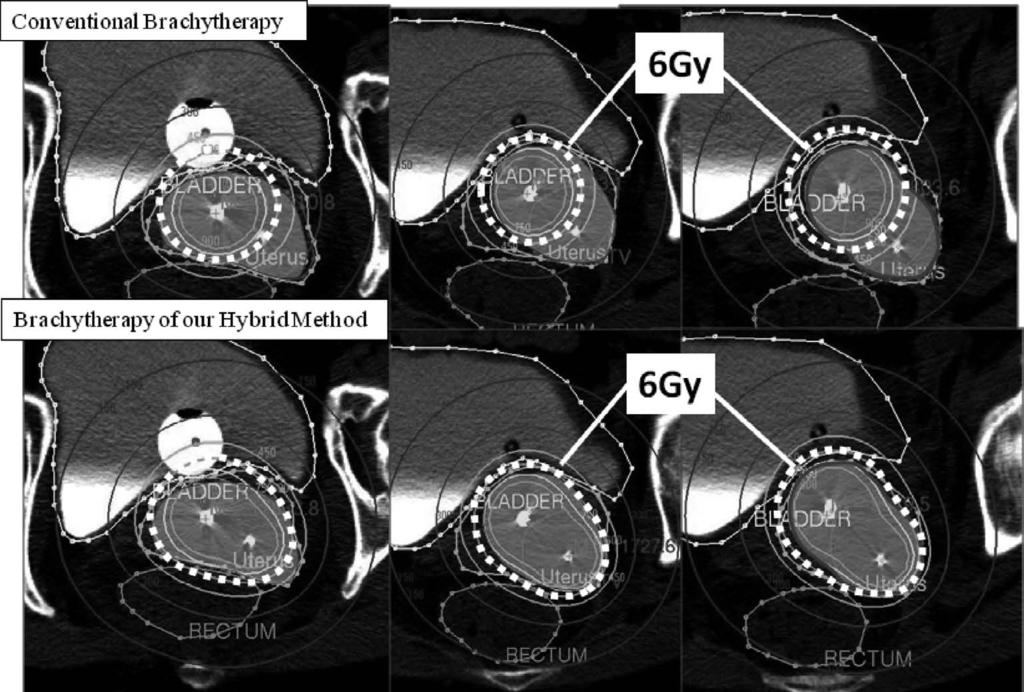 56 M. Wakatsuki et al. defined as the parameter of ICBT in the GYN GEC ESTRO recommendation and for organs at risks (OARs) such as bladder, rectum and sigmoid colon.