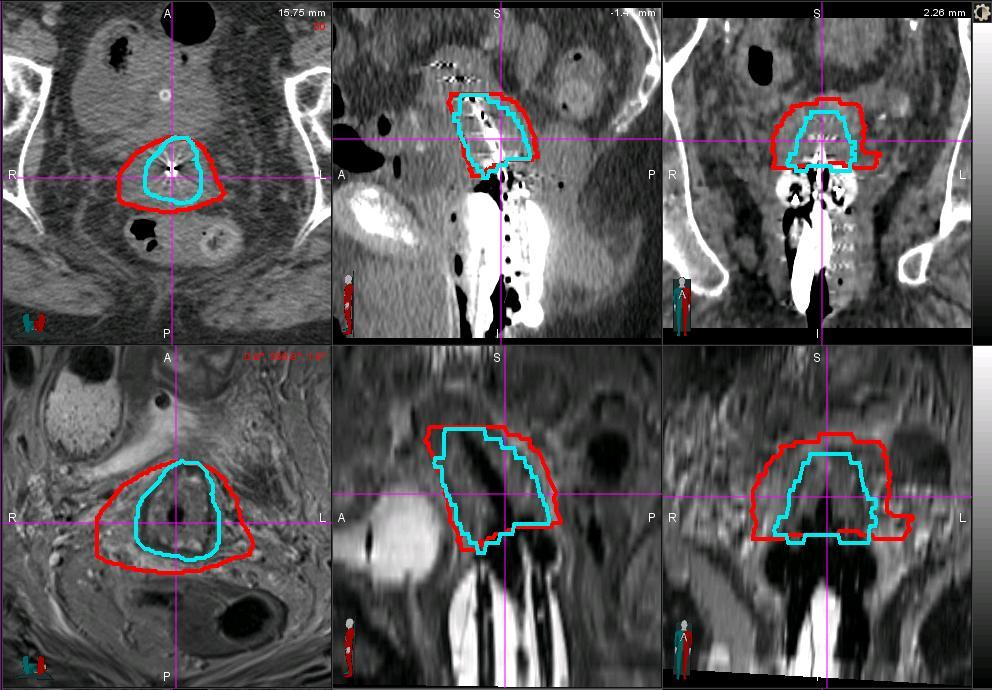 CT (red) vs. MR (blue) for IGBT For all 3 cases, the mean tumor volume was smaller on MR than on CT (P<.