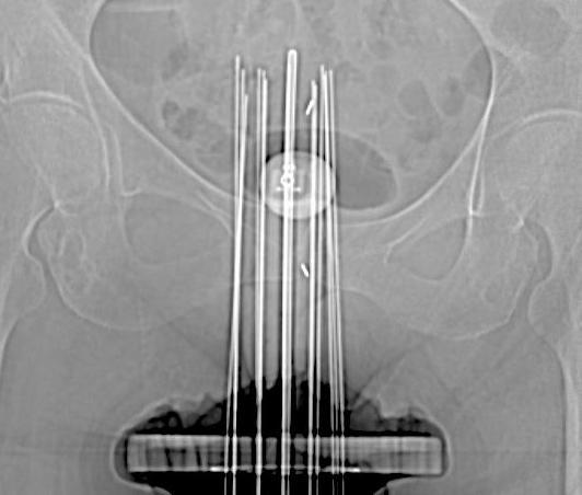 Indications for Interstitial Implant for Stage IIIA Cervix Cancer Large