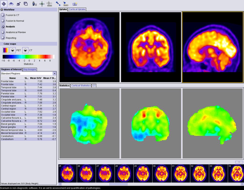 PET/CT možganov z 18 F-FDG Scenium