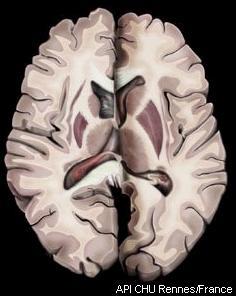 Dopaminski prenašalec (DAT) Presinaptični dopaminski nevron kaudatus putamen Postsinaptični dopaminski nevron Enofotonska emisijska tomografija (SPECT) z 123
