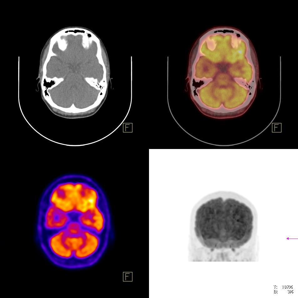 PET/CT možganov z 18 F-FDG 14 letno