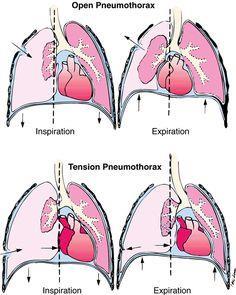 Pneumothorax a hole in the pleura due to injury of chest wall, lung disease, etc.