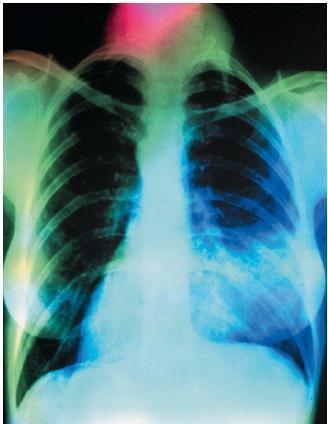 Dead space (V D ) - parts of respiratory passageways where no significant gas exchange occurs between lungs and blood 1.