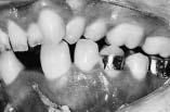 The patient was instructed to wear the maxillary retainer full time for a year and at night thereafter.