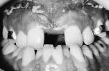 The maxillary first premolars replaced the missing canines in the esthetic and functional aspects; to achieve good function,