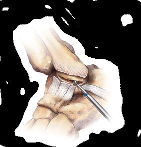 This step also exposes the Calcaneofibular ligament (CFL) which lies just beneath the peroneal tendons in this location and is easily located by toeing-in the senn rake (Figure 3).
