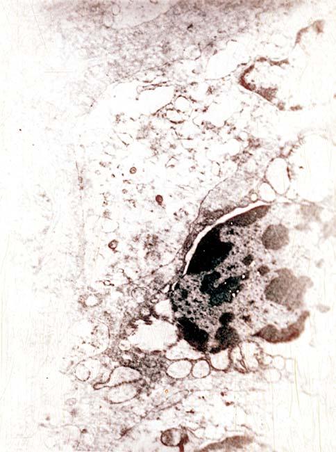 fibroblast with condensed nucleus, three cells of lymphocyte origin,