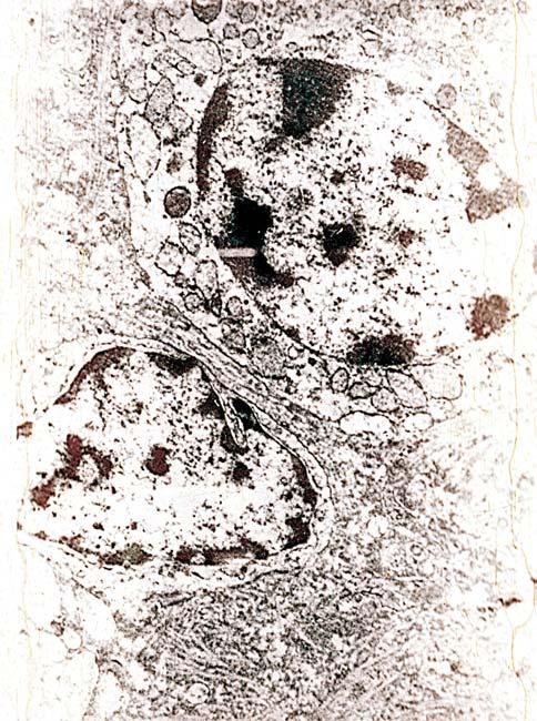 70 V. Deva et al. Figure 5 Plasmacytes.