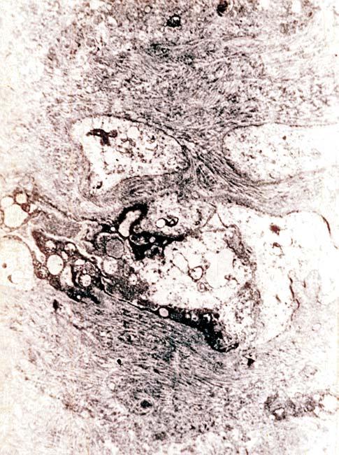 plasmacyte (EM image, 4 600) Figure 7 Area