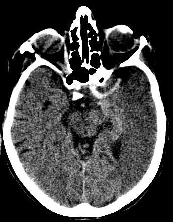 Romanian Neurosurgery (2011) XVIII 4: 442-449 Figure 1 NECT in a 49 years old patient presented with high density in the left proximal middle cerebral artery and acute infarction with loss off the
