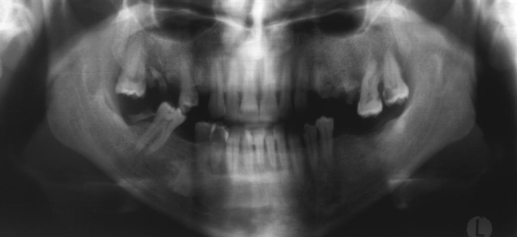 For the second group of pacient age withe ischemic stroke the dental imaging caracteristic were progressive marginal periodontitis wite horizontal and vertical damage around the premolar apex and