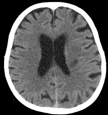 Romanian Neurosurgery (2011) XVIII 4: 442-449 447 Figure 4 NCCT to a 34 year old patient with progressive marginal
