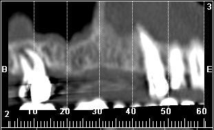 right posterior mandibular area, very well visible with the very small oblique longitudinal reconstruction on the