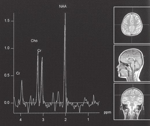 MR Spectroscopy of Psychomotor Delay elin damage, loss of normal myelin, synaptic intensity, or a reduction in the number of neurons.