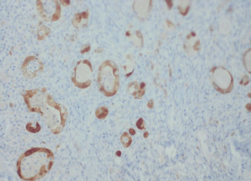 C, The tumor cells show strong nuclear expression of the transcription factor PAX8 (immunohistochemistry for PAX8, original magnification