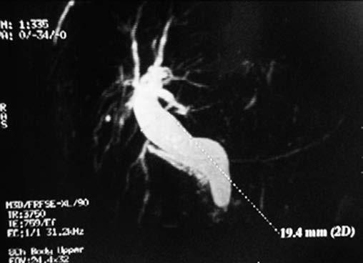Biliary Stricture After a Roux-en-Y Gastric Bypass with Remnant Gastrectomy, Navarrete Llopis S et al.
