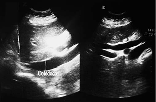 Figure 2. Abdominal ultrasonogram showing evidence of persistent important dilation of the common bile duct. polyglactin interrupted stitches in a single layer (Figure 4).