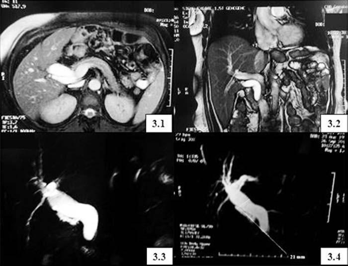 Biliary Stricture After a Roux-en-Y Gastric Bypass with Remnant Gastrectomy, Navarrete Llopis S et al. Figure 3.