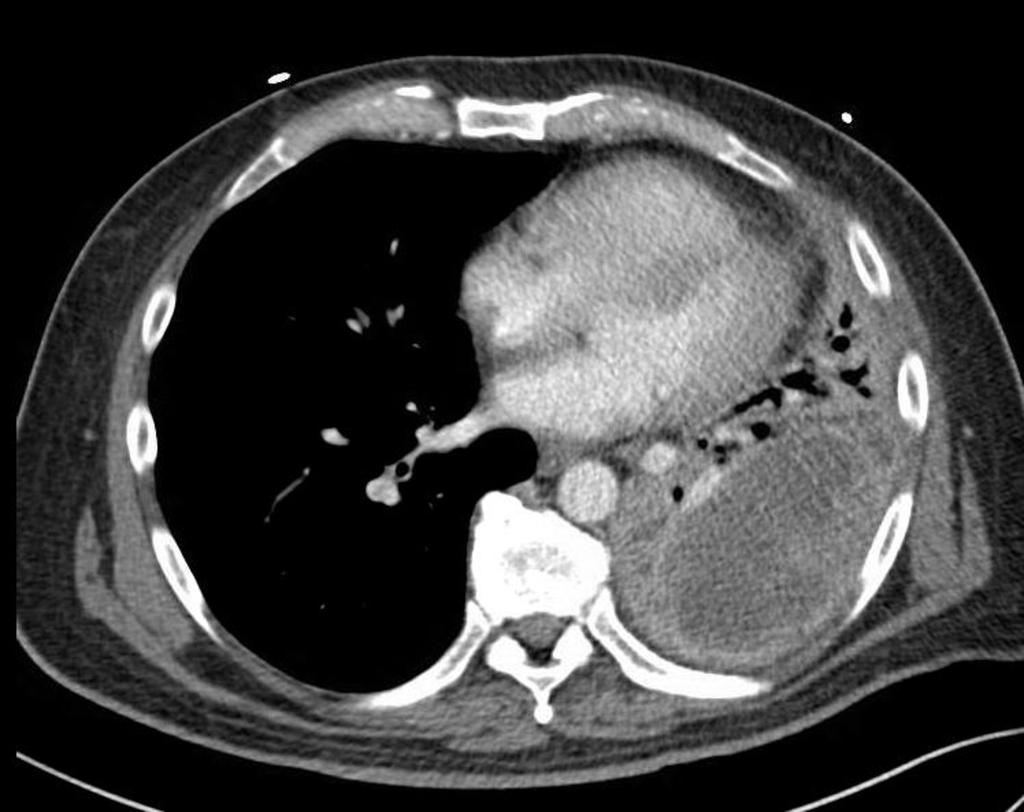 FIGURE 1: Mass with internal enhancing septa centered in the left lower lobe and measuring
