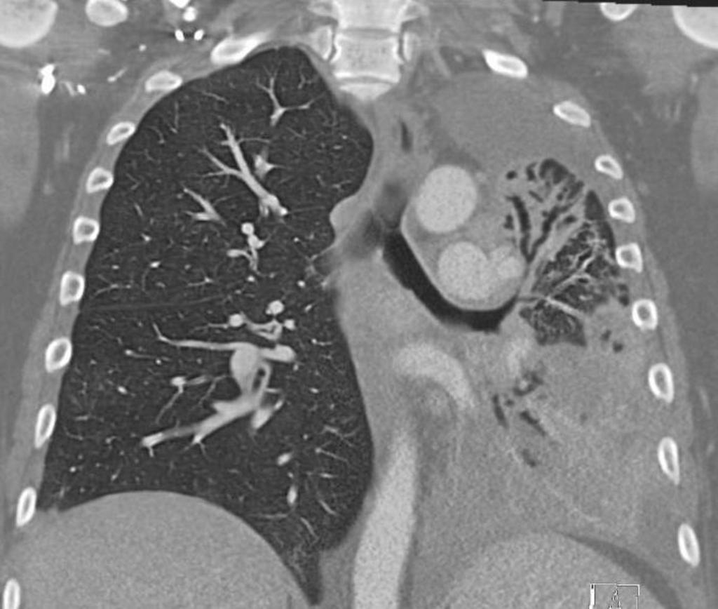 FIGURE 2: Coronal section on CT chest showing endobronchial lesion with extrinsic compression of the left main stem