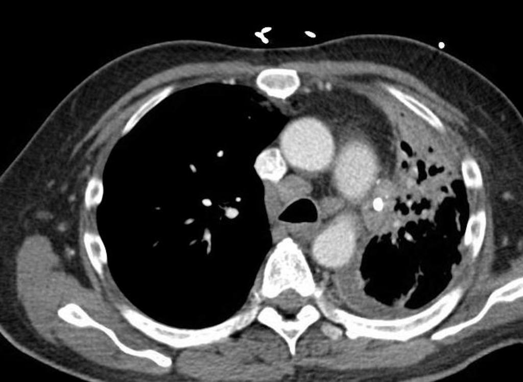 FIGURE 3: Multiple enlarged mediastinal and bilateral hilar lymph nodes Based on the initial laboratory values and CT findings of a mass in the left lower lobe, the patient was diagnosed with STLS as