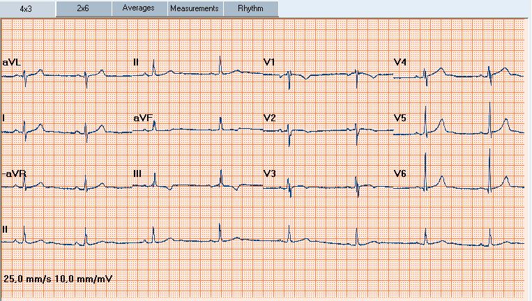 Workspace Parameters Interpretation 1.3. Resting ECG Views Welch Allyn CardioPerfect Webstation offers various views on an ECG. Each view highlights a different aspect of the ECG.