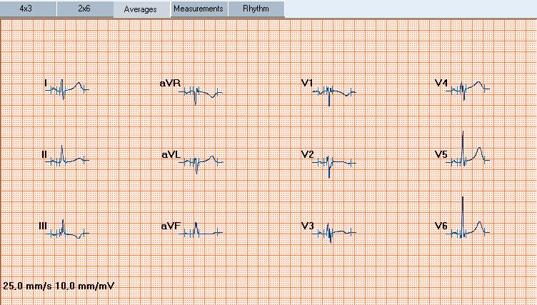 Averages view The Averages view displays the averages of the dominant complexes for all 12 leads. You can also view a single average complex, display markers and compare complexes of other ECGs.