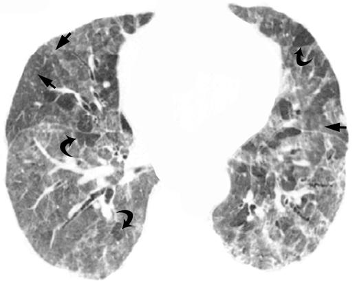 CT of Hypersensitivity Pneumonitis Fig. 14 74-year-old man with chronic and subacute hypersensitivity pneumonitis (bird fancier s lung).