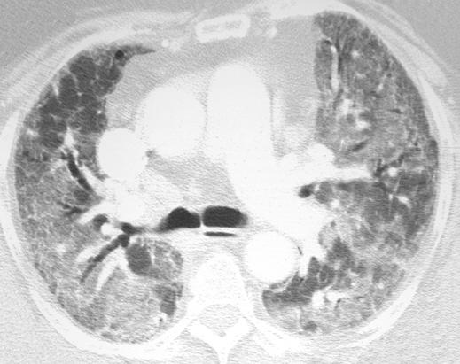 This type of bronchiolitis presumably accounts for lobular areas of decreased attenuation and vascularity seen on high-resolution CT.