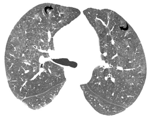 CT of Hypersensitivity Pneumonitis Fig. 2 41-year-old man with subacute hypersensitivity pneumonitis.