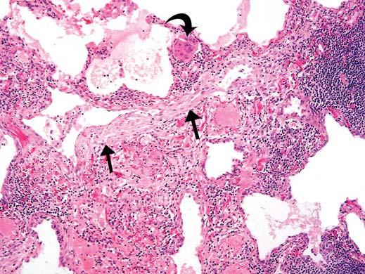 (H and E, 40) D, Higher-power view shows chronic interstitial inflammatory infiltrate and interstitial fibrosis. lso evident are giant cell (curved arrow) and fibroblast focus (straight arrows).