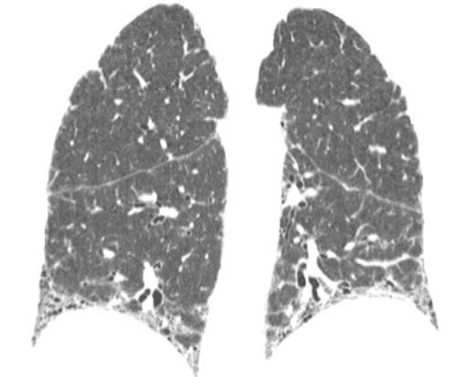 , High-resolution CT scan shows bilateral reticulation, traction bronchiectasis (curved arrow), and traction bronchiolectasis (straight arrows).