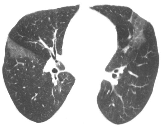 CT of Hypersensitivity Pneumonitis Fig. 9 47-year-old man with subacute hypersensitivity pneumonitis (bird fancier s lung).