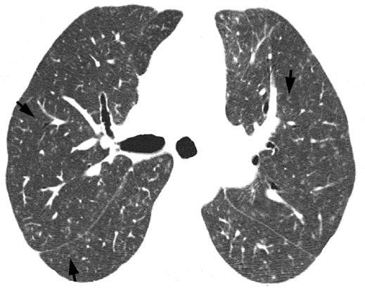 Fig. 11 45-year-old woman with subacute hypersensitivity pneumonitis (winemaker s lung).