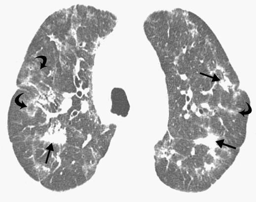 13 55-year-old man with hypersensitivity pneumonitis due to exposure to mold.