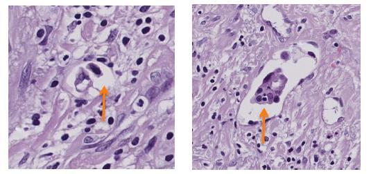 Muscle invasive bladder cancer Advantage of objective quantification through image analysis Kohen s Kappa = 0.11 p= 0.