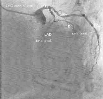 (Left) The MPS shows moderate reversible myocardial ischaemia in a moderate sized area at the apex and the antero-apical wall.