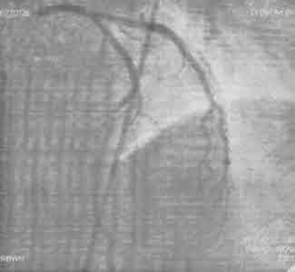 (Left) The MPS shows mild reversible myocardial ischaemia in a small area at the apex, (Top Right) G-SPECT images show