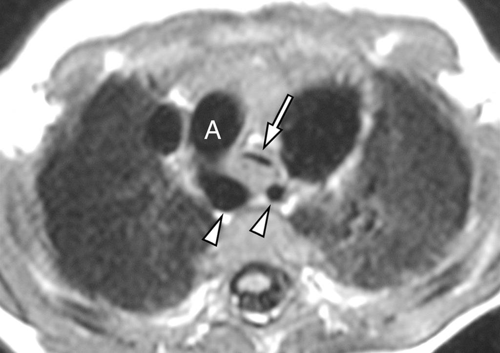 The imaging findings reviewed included the presence of airway narrowing and, if present, the supe- rior to inferior level of airway narrowing (at the level of the aberrant subclavian artery, aortic