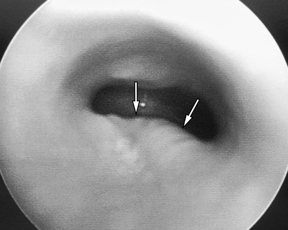 Donnelly et al. 3). ll such patients had both Kommerell s diverticulum and midline descending aorta resulting in the airway compression.