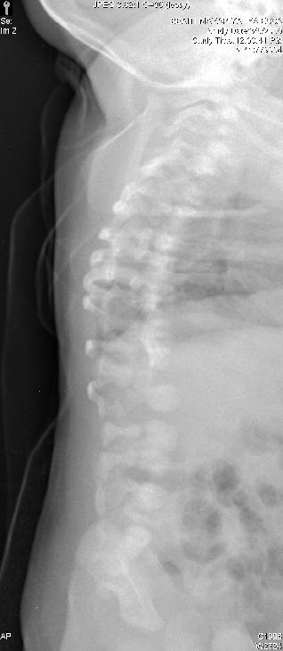 626 TARIQ AL ZAHRANI ductus arteriosus defect (PDA). His plain X-ray revealed spinal vertebrae deformity. She was scheduled to have a diagnostic MRI under general anesthesia.