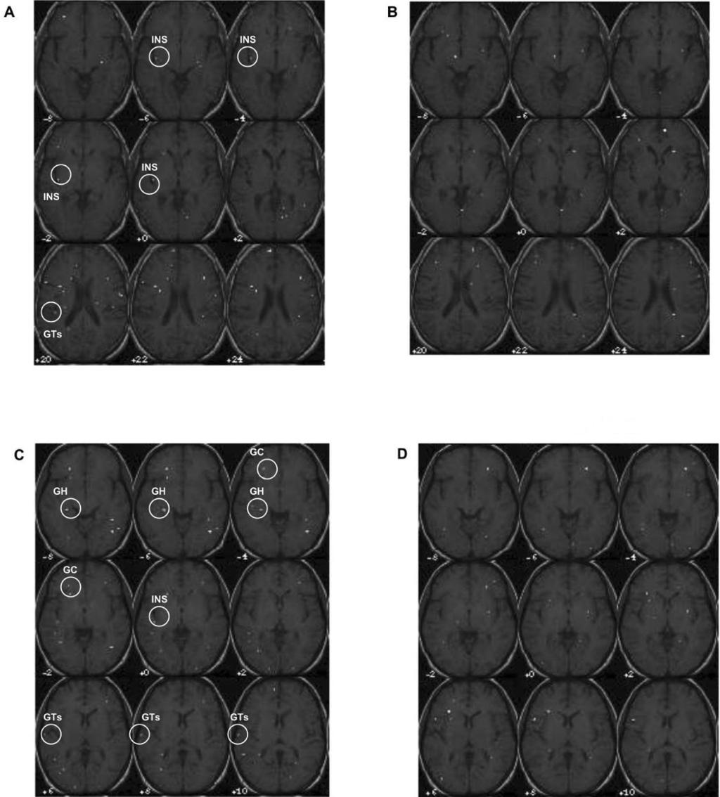 FUNCTIONAL MRI AND FOOD-RELATED BRAIN ACTIVITY 1017 TABLE 4 Group-level analysis of responses to food stimuli greater than nonfood stimuli, using voxel-level P 0.