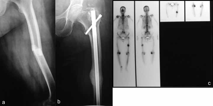 Treatment of atypical femoral fractures 593 crack repair. Finally, anti-angiogenic effects of BPs are clearly implicated.