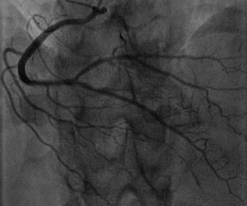 effort-induced chest pain. (a) Invasive coronary angiography demonstrates a proximal narrowing of 50% of the left main (LM) vessel.