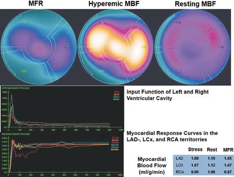 (e) Regional myocardial blood flow quantification (MBF) and myocardial flow reserve (MFR) calculation with 13 N-ammonia PET/CT and tracer kinetic modeling.