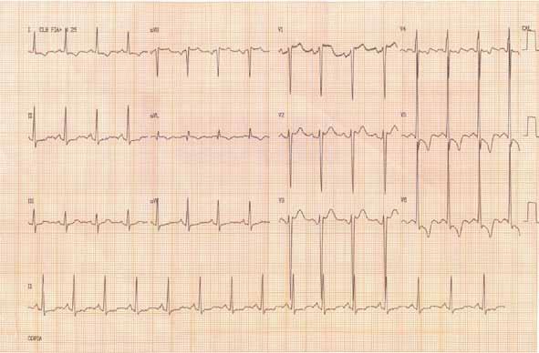 Figure 1 ECG of 51-year-old female patient with stage-3 arterial hypertension.