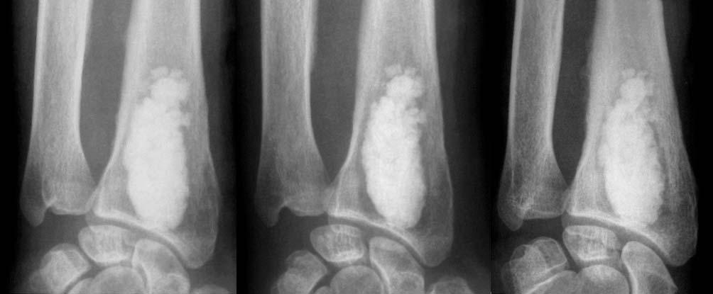 CLINICAL CASE Filling of distal radius Male, 64 years Laurent OBERT, MD, Besançon (France) Filling of distal radius