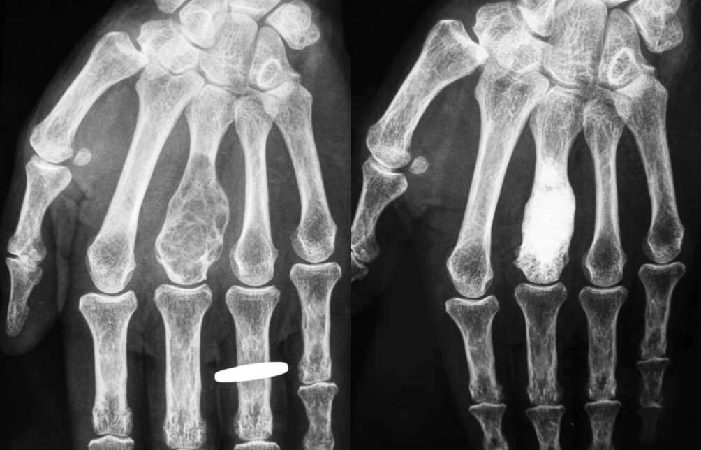 CLINICAL CASE Chondroma, 3 rd metacarpal Female, 61 years Dominant side: right ; injured side: left Philippe